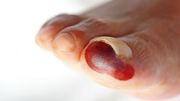 腳面凸起一個(gè)硬包是什么原因