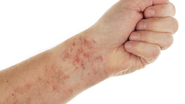 HPV16在HPV中是感染最多的嗎