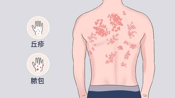 越抓越癢是哪種皮膚病