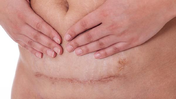 剖腹产多久可以练瑜伽普拉提