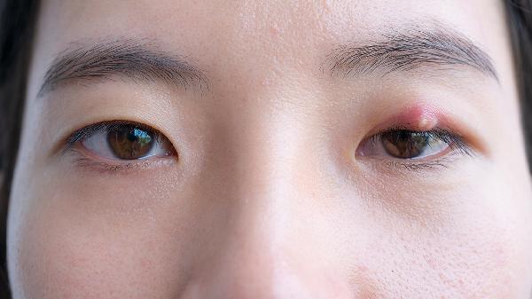 單純性突眼和浸潤性突眼的臨床表現(xiàn)