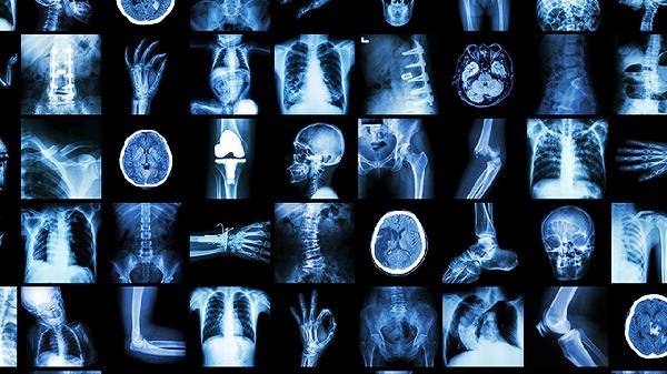 十六岁骨骼线闭合了怎么还能再长