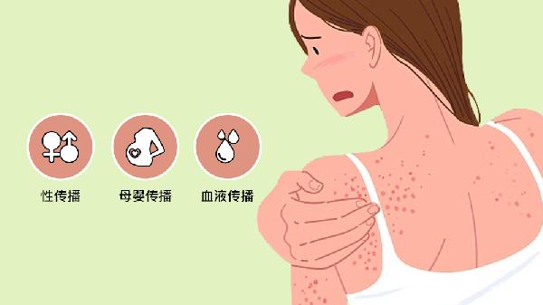 梅毒1比2阳性会不会传染给别人