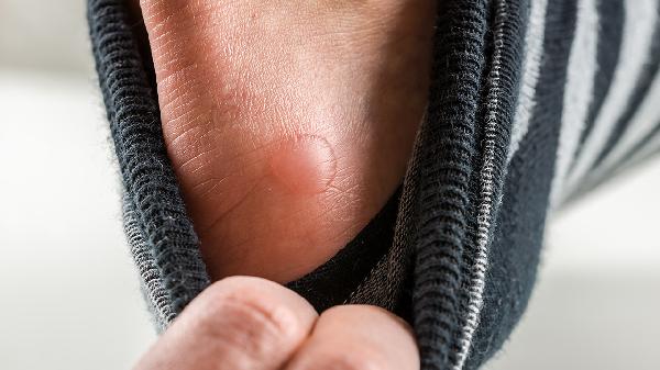 男生生殖长了个水泡是怎么回事儿