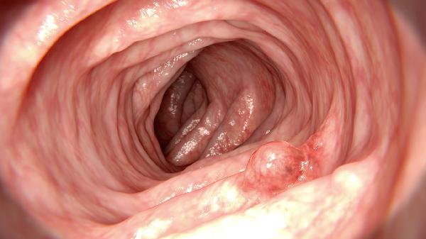 前庭大腺炎会变成前庭大腺囊肿吗