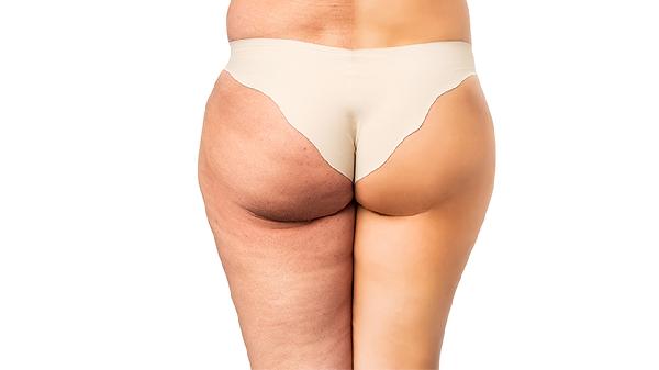 女性臀部大怎么回事