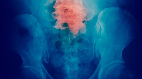 肺恶性肿瘤的治疗方法有哪些药物