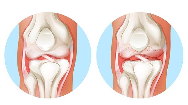 软骨损伤有积液正常多长时间能好