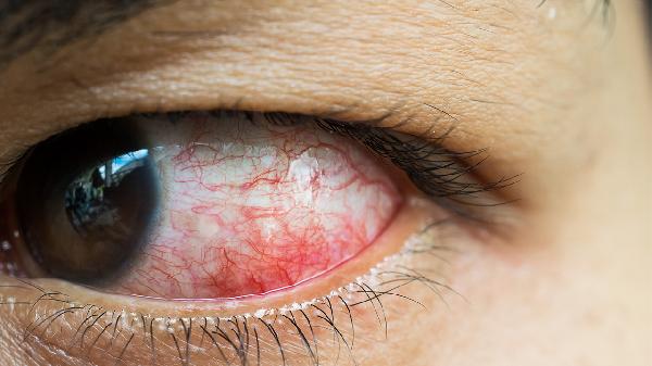 慢性结膜炎畏光爱流眼泪怎么办