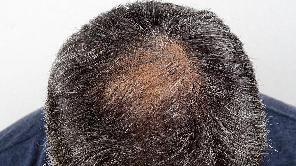 长出白头发，还能变黑吗？这6个方法是骗人的，别交智商税
