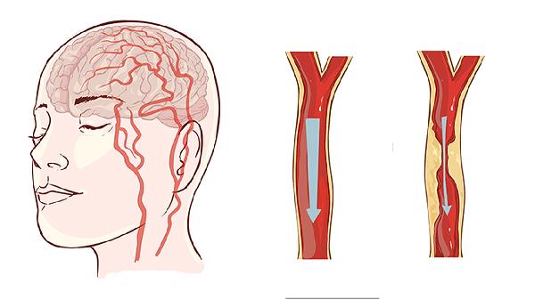 小兒腦性癱瘓的治療方法有哪些