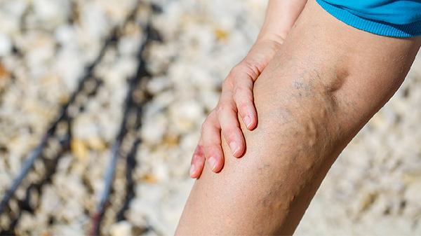 精索静脉曲张有影响生育问题吗