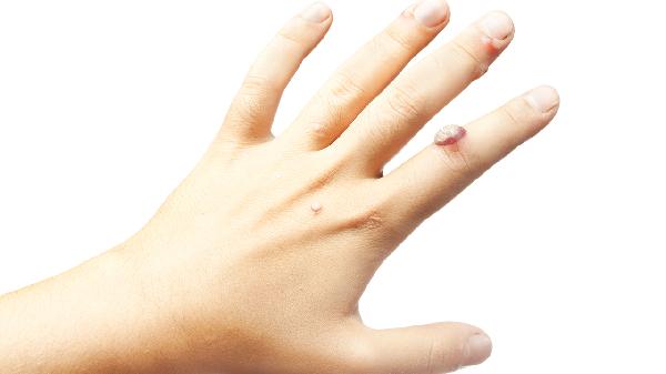 女性假性尖锐疣会不会越来越严重