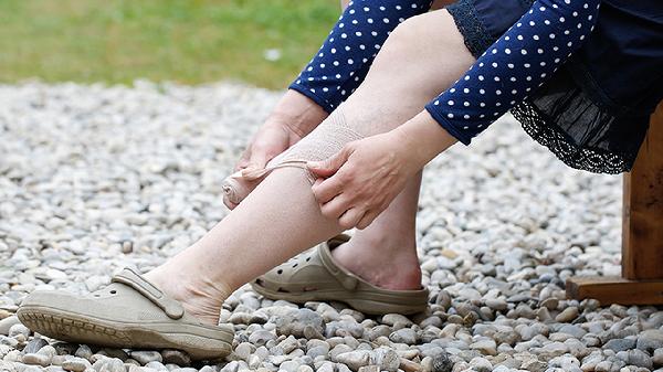 腿上有纹路是怎么回事女44岁了