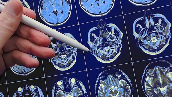 新生兒梗阻性腦積水造瘺成功率高嗎能治好嗎