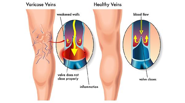 腿摔破了一直流水怎么回事
