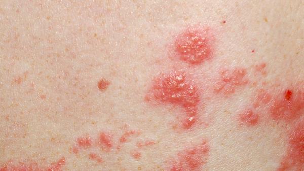 低危HPV61阳性多久转阴
