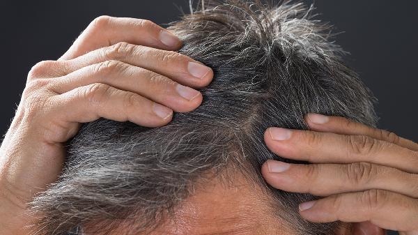 长头癣怎么治疗 4个办法巧妙解决头癣
