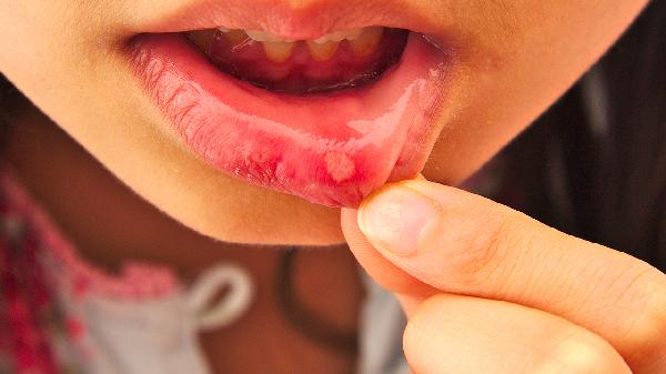 老年人消化性溃疡的治疗方法