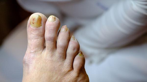 指甲营养不良如何治疗好得快