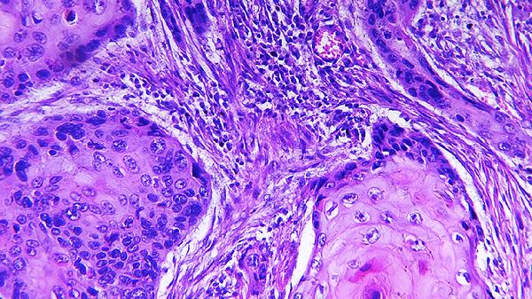 神经病变如何治疗 治神经病变的三个方法分享