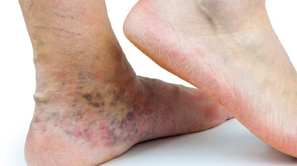 大腿根部有肿块怎么办 大腿根部有肿块的几个原因分析