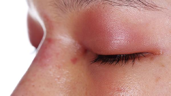 红斑狼疮脸上会莫名的发红吗