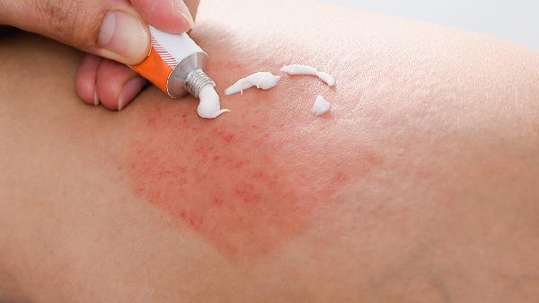 大腿内侧湿疹初期症状