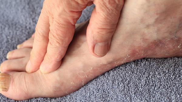 8岁孩子扁平足可以矫正吗