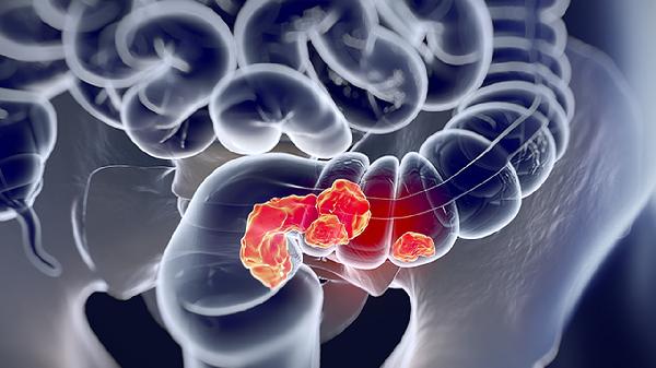 用什么东西能去除猪大肠的臭味