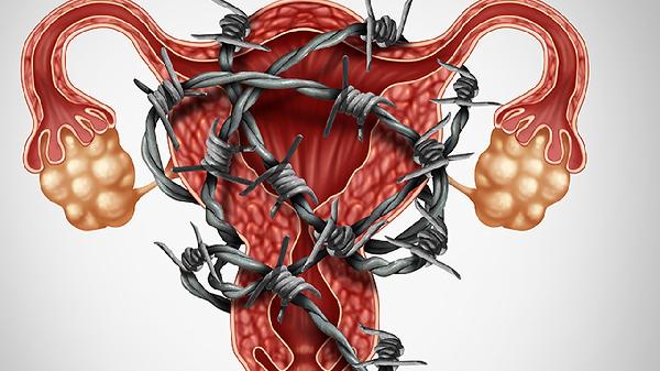 女孩卵巢囊肿怎么治疗效果好