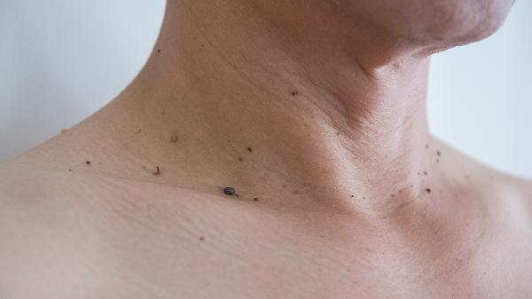色素痣会不会变成黑色素瘤