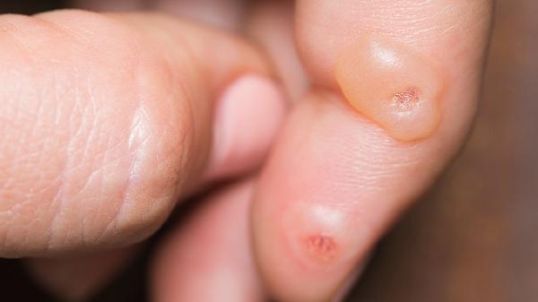 阴旁边长水泡是怎么回事该咋办