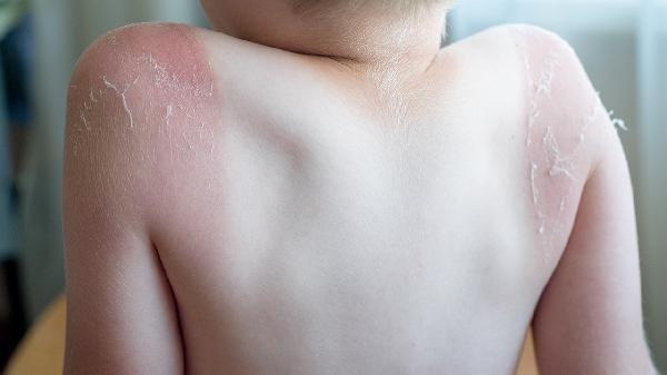 深二度烫伤可以用碘伏消毒吗