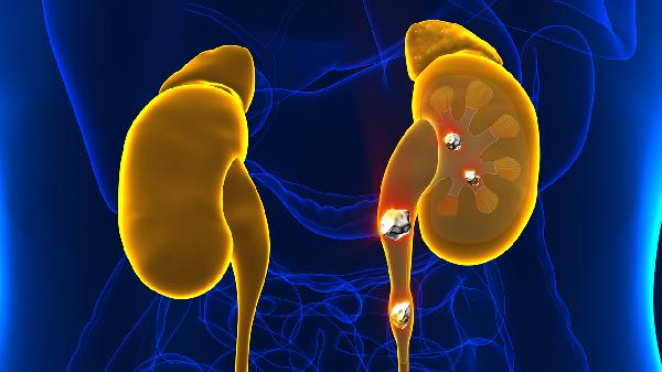 肾积水伴输尿管狭窄是什么