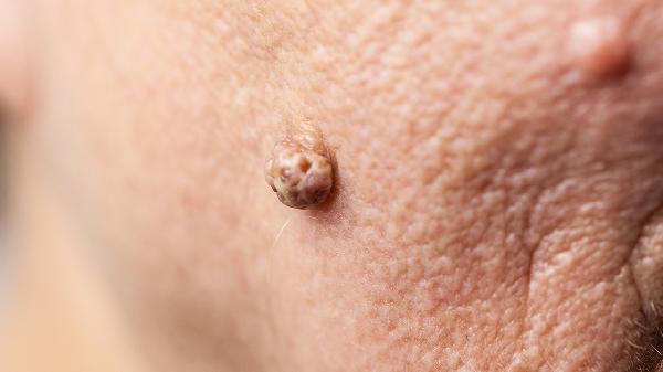 皮肤纤维瘤是良性肿瘤吗严重吗