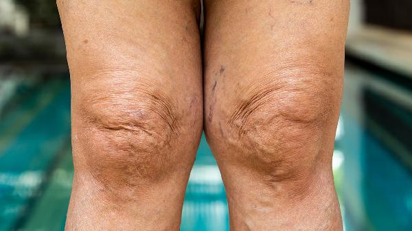 膝盖下面的骨头突出是怎么回事