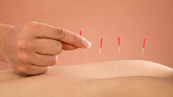 腰扭伤可以针灸治疗吗 腰扭伤能不能针灸