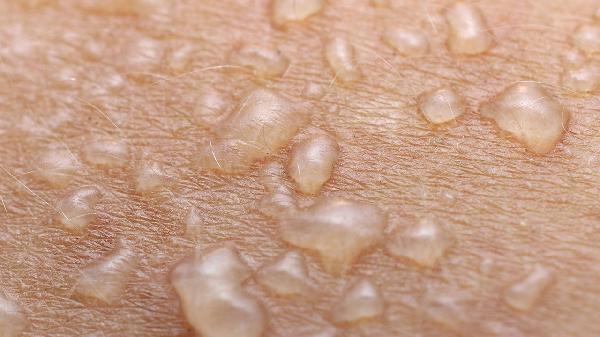 燙傷后用熱水泡還是冷水 燙傷后這些處理常識要知
