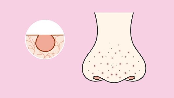 如何去掉黑头小窍门