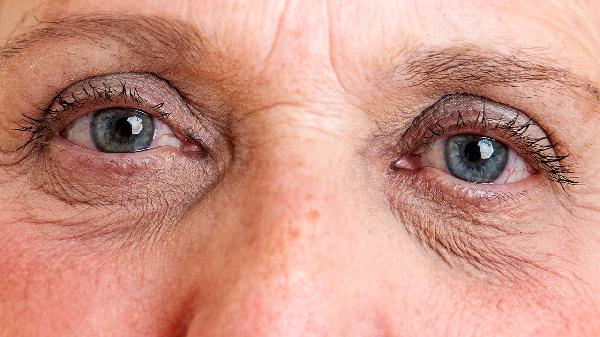 容易长皱纹的体质