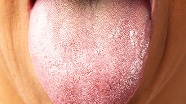 舌头溃疡10秒治愈方法