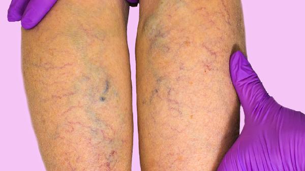 夹腿综合症最严重的行为