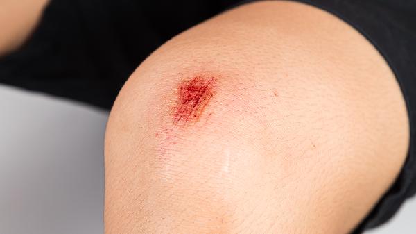 伤口好了之后留下的黑印是怎么回事