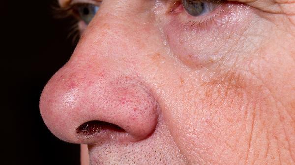 吃菠菜可预防老年眼病 预防老年眼病 可多吃这些护眼食物