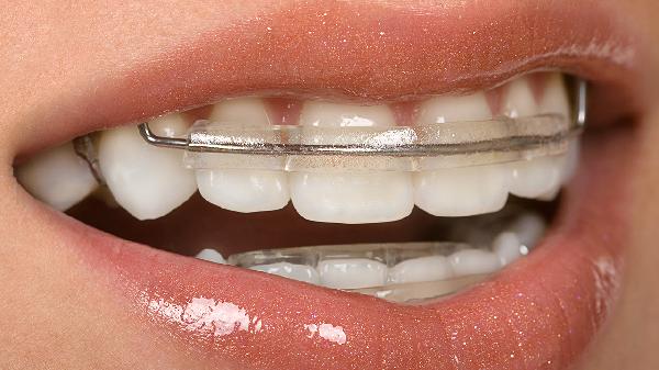 牙齿矫正器普通的和自锁型的有什么区别