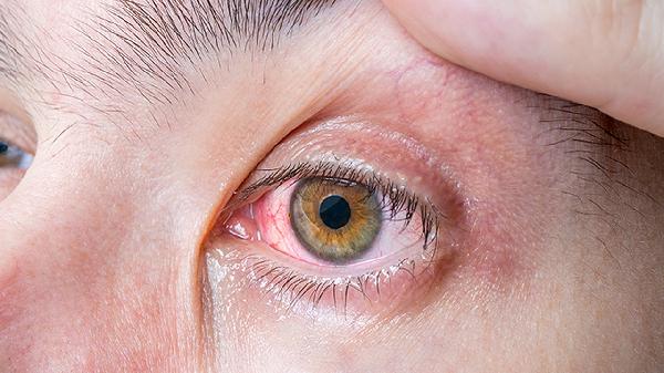 如何预防干眼症 不得不说的8个预防干眼小妙招