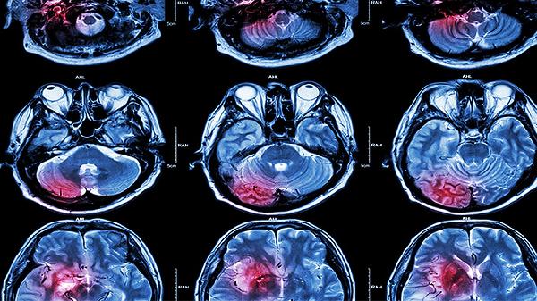80岁脑梗死患者恢复期头发变黑怎么回事