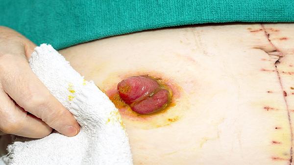儿童腹股沟疝与成人有哪些区别