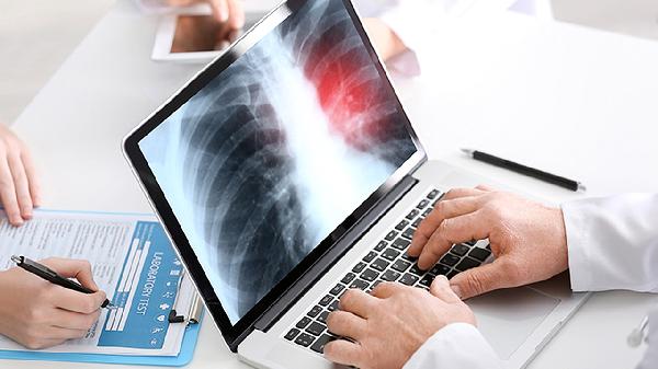 肺癌需要做什么检查  肺癌患者这6个检查必做